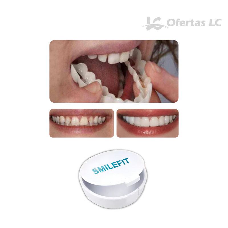 Facetas Odontológicas Removíveis - SmileFit - Cobre falhas, Quebras e Manchas