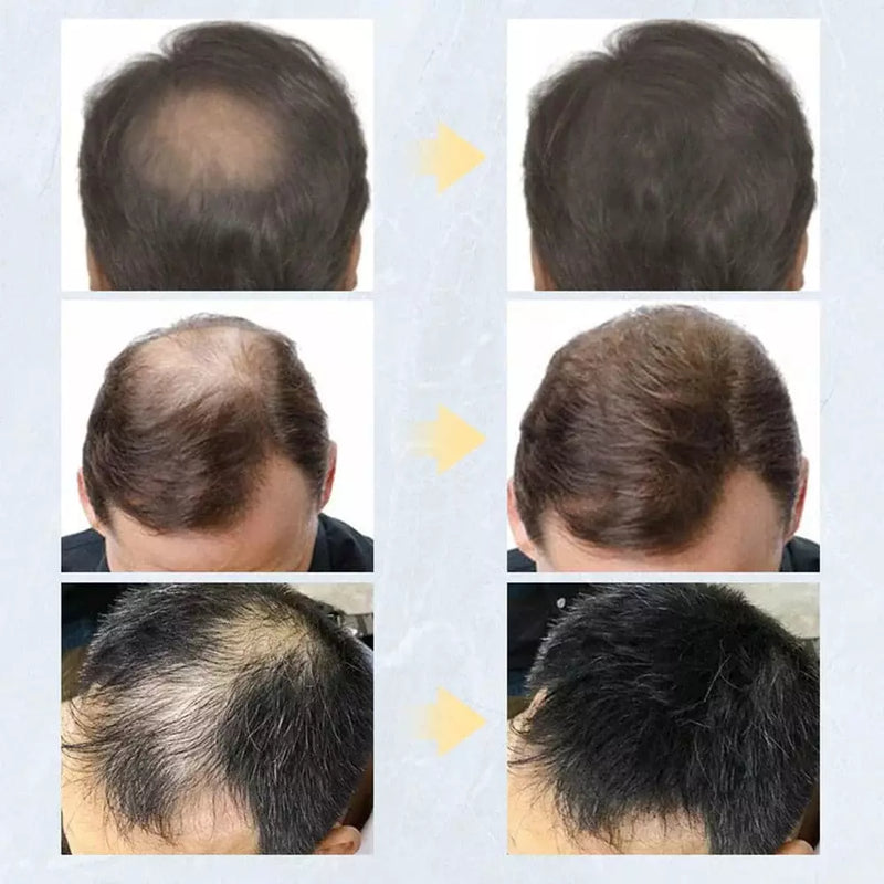 Kit Toppik Hair - Disfarce instantâneo da calvície