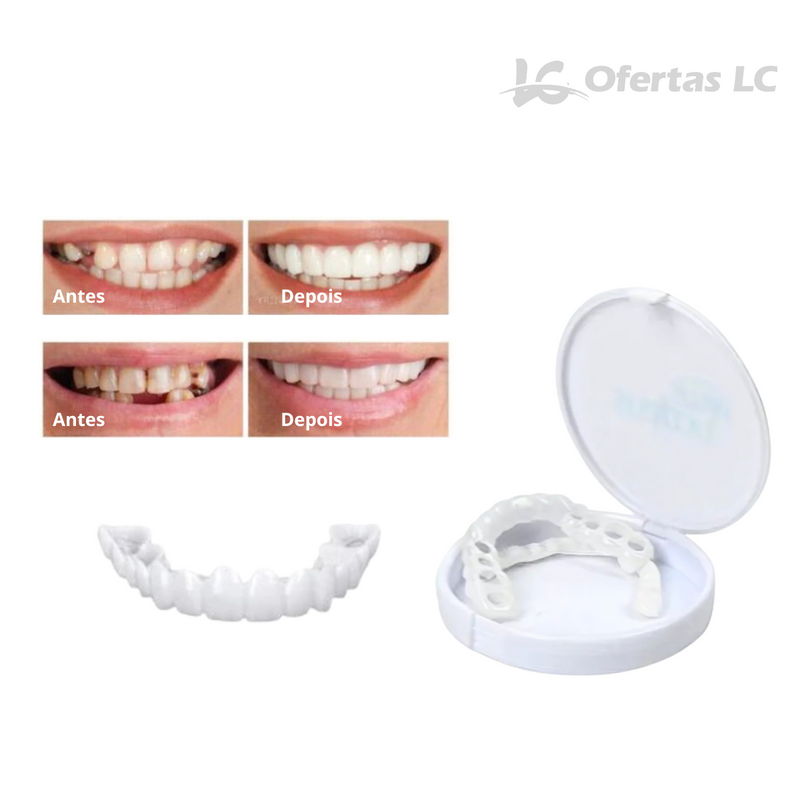 Facetas Odontológicas Removíveis - SmileFit - Cobre falhas, Quebras e Manchas